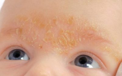 Раздражение кожи головы у детей