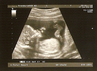 Фото УЗИ 15 неделе беременности
