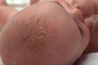 Cradle cap on a baby
