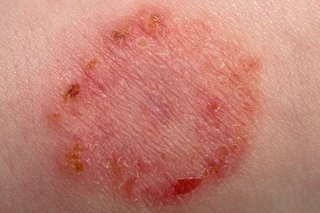 Ringworm rash on the skin