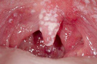 White patches inside mouth caused by oral thrush