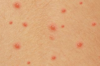 Small red spots, filled with fluid, on white skin.