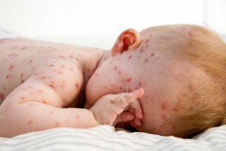 Small baby with red spots on face, arms and body