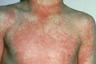 Scarlet fever rash on a child