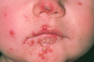 Young child with impetigo sores and blisters on their face