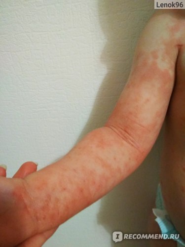 Отзыв на реакцию Манту у трехлетнего ребенка. Аллергическая реакция - противопоказание к проведению подкожных проб. Медотвод.