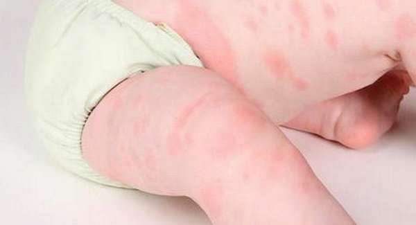 после прививки АКДС у детей могут быть такие последствия как аллергическая реакция.