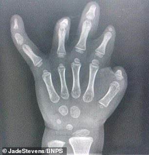 This is an X-ray of his hand. The condition means he has almost no thumb and index inger