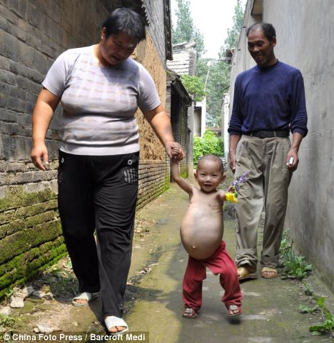 Kang Mengru with her parents before surgery to remove the parasitic twin growing inside her stomach