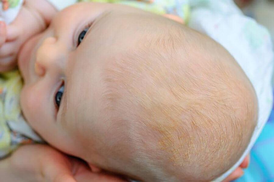 Молочные корочки у младенца