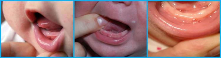 Как выглядят набухшие десна ребенка в период прорезывания первых зубов: симптомы у грудничка с фото