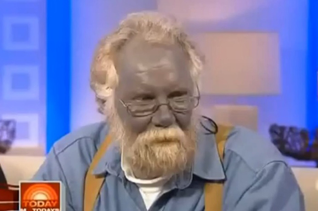 Пол Карасон, страдавший синдромом голубой кожи.