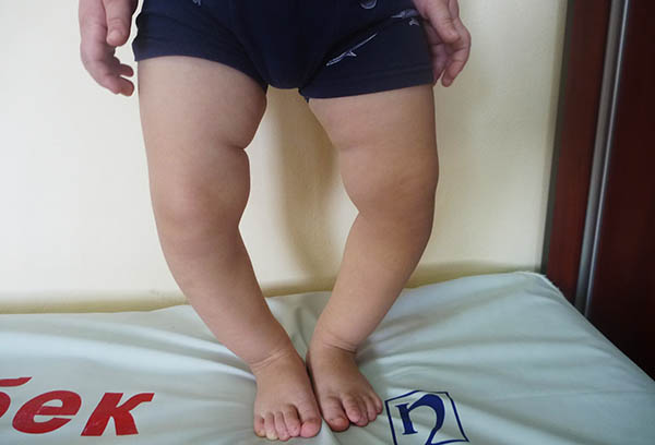 Ноги больного рахитом ребенка