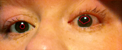 Misshapen pupil due to Iritis-caused synechia in the left eye