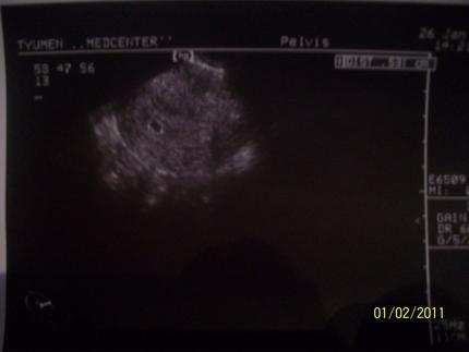 УЗИ -5 недель беременности