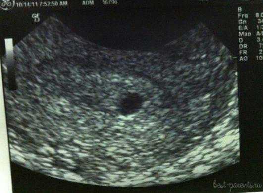 Беременность 5 недель можно. Снимок УЗИ беременности 5-6 недель. УЗИ 5-6 недель беременности.